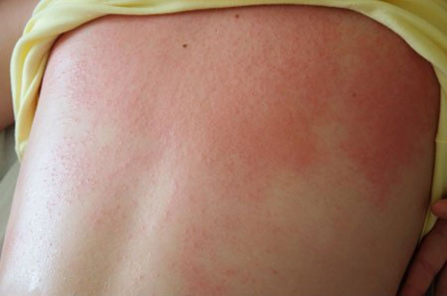 rom - Các bệnh ngoài da ở trẻ cần được các bậc phụ huynh lưu ý và cảnh giác
